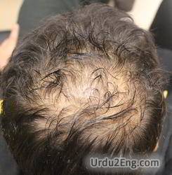 alopecia Urdu Meaning