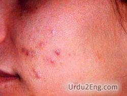 acne Urdu Meaning