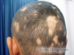 alopecia Urdu Meaning