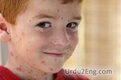 chickenpox Urdu Meaning
