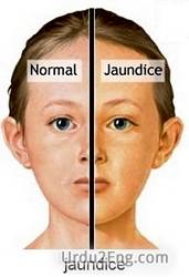 jaundice Urdu Meaning
