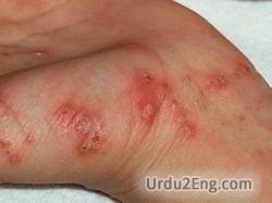 scabies Urdu Meaning